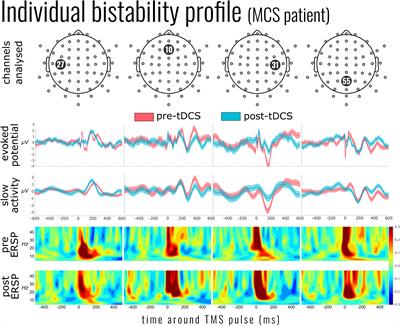 Decreased Evoked Slow-Activity After tDCS in Disorders of Consciousness